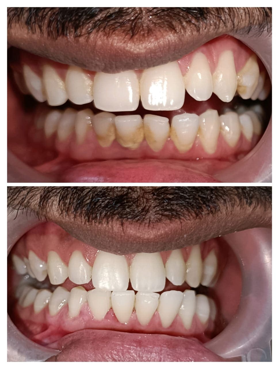 Treatment Result 10 - Dental procedure outcome