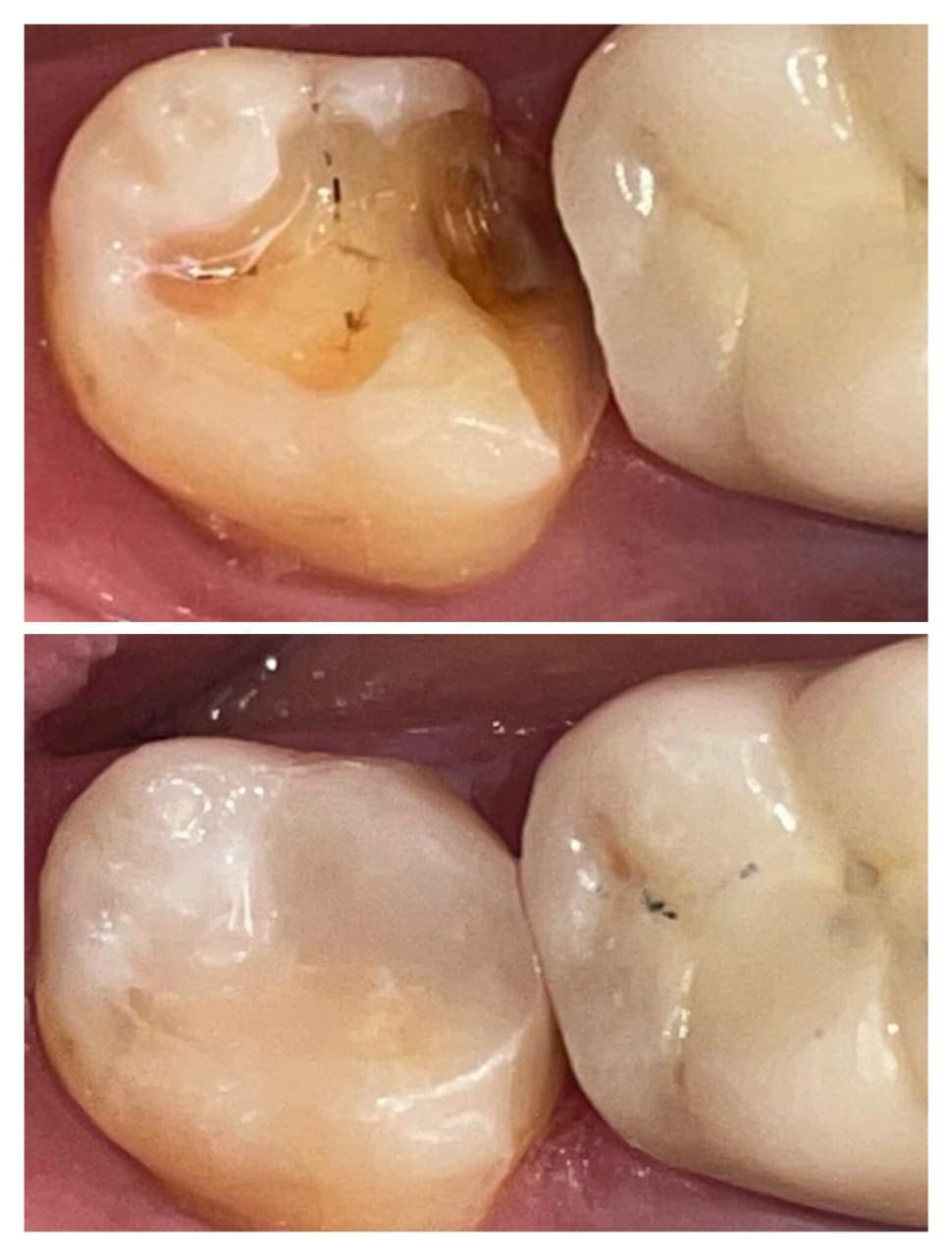 Treatment Result 11 - Dental procedure outcome