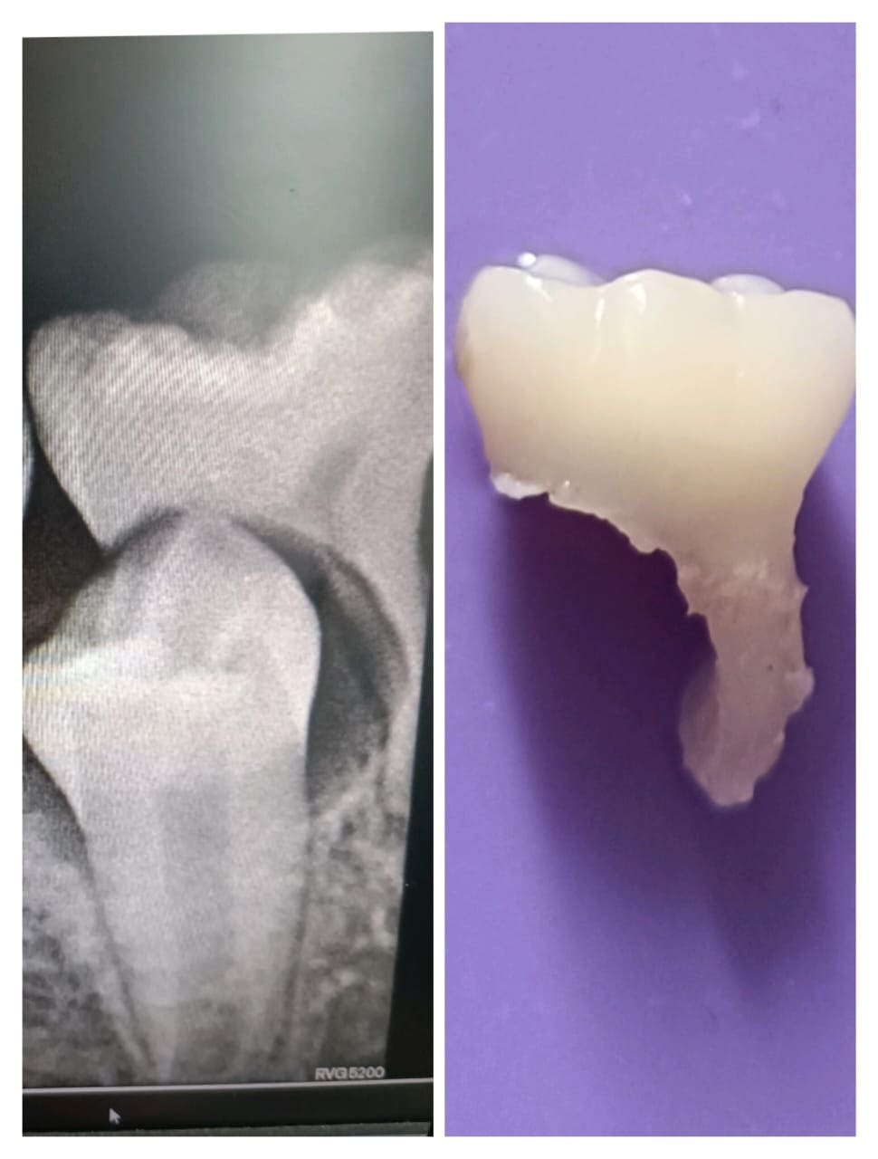 Treatment Result 12 - Dental procedure outcome