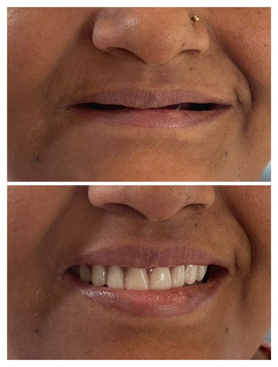 Treatment Result 13 - Dental procedure outcome