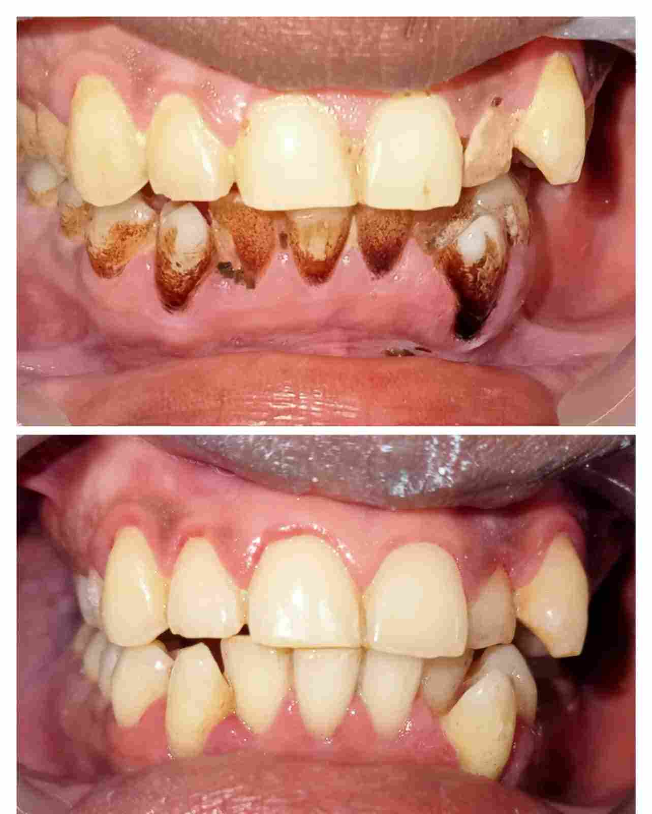 Treatment Result 5 - Dental procedure outcome