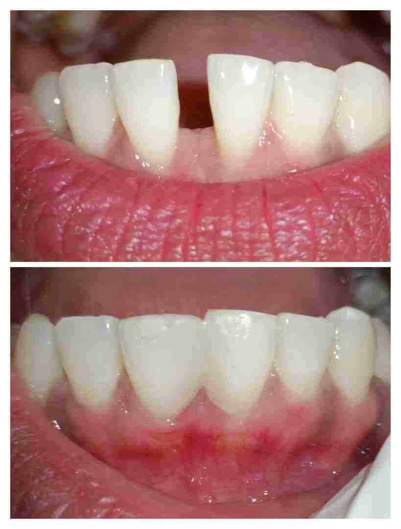 Treatment Result 6 - Dental procedure outcome