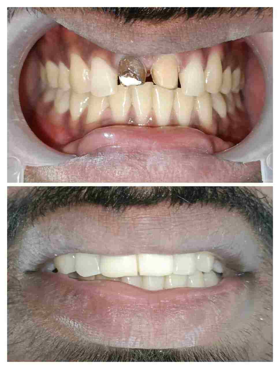 Treatment Result 7 - Dental procedure outcome