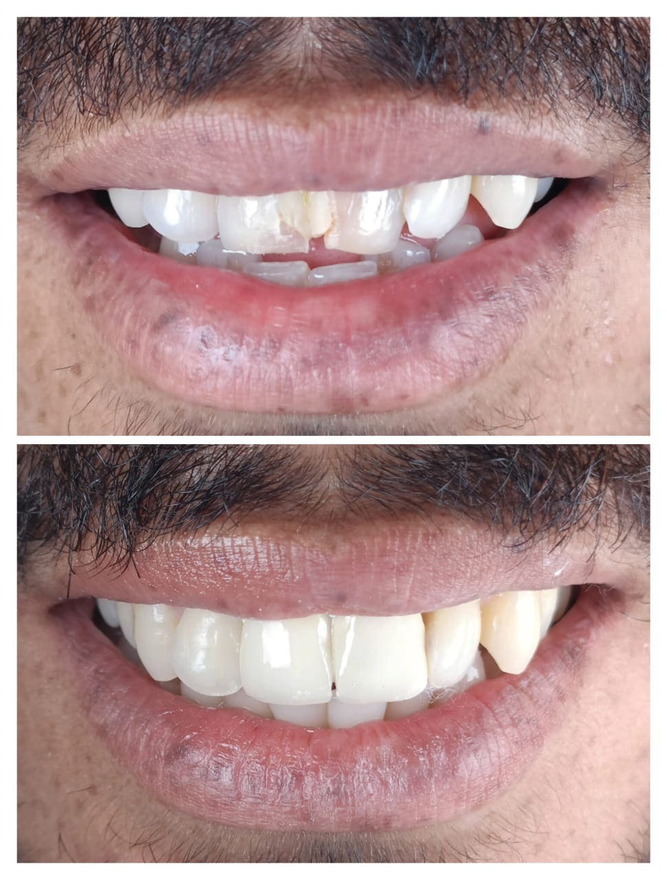 Treatment Result 8 - Dental procedure outcome