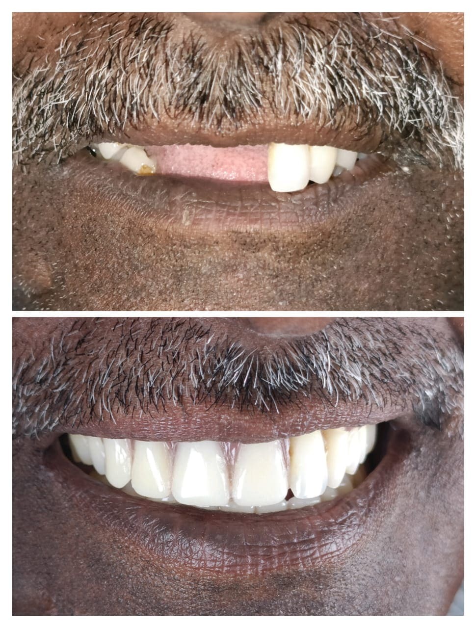 Treatment Result 9 - Dental procedure outcome